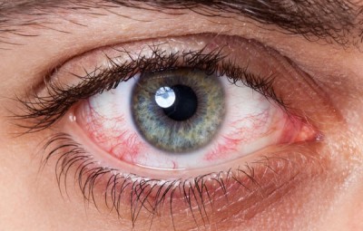 درمان خشکی چشم و راه های پیشگیری از  آن