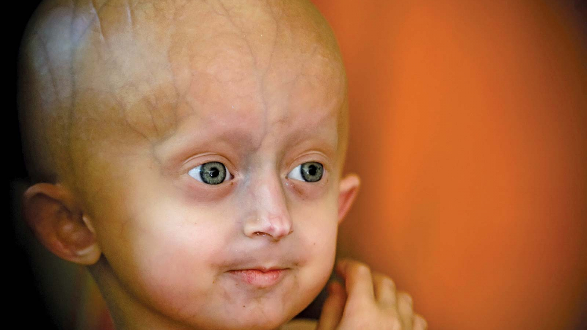 نام دیگر progeria چیست و چه نشانه هایی دارد