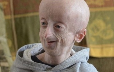 نام دیگر progeria چیست و چه نشانه هایی دارد