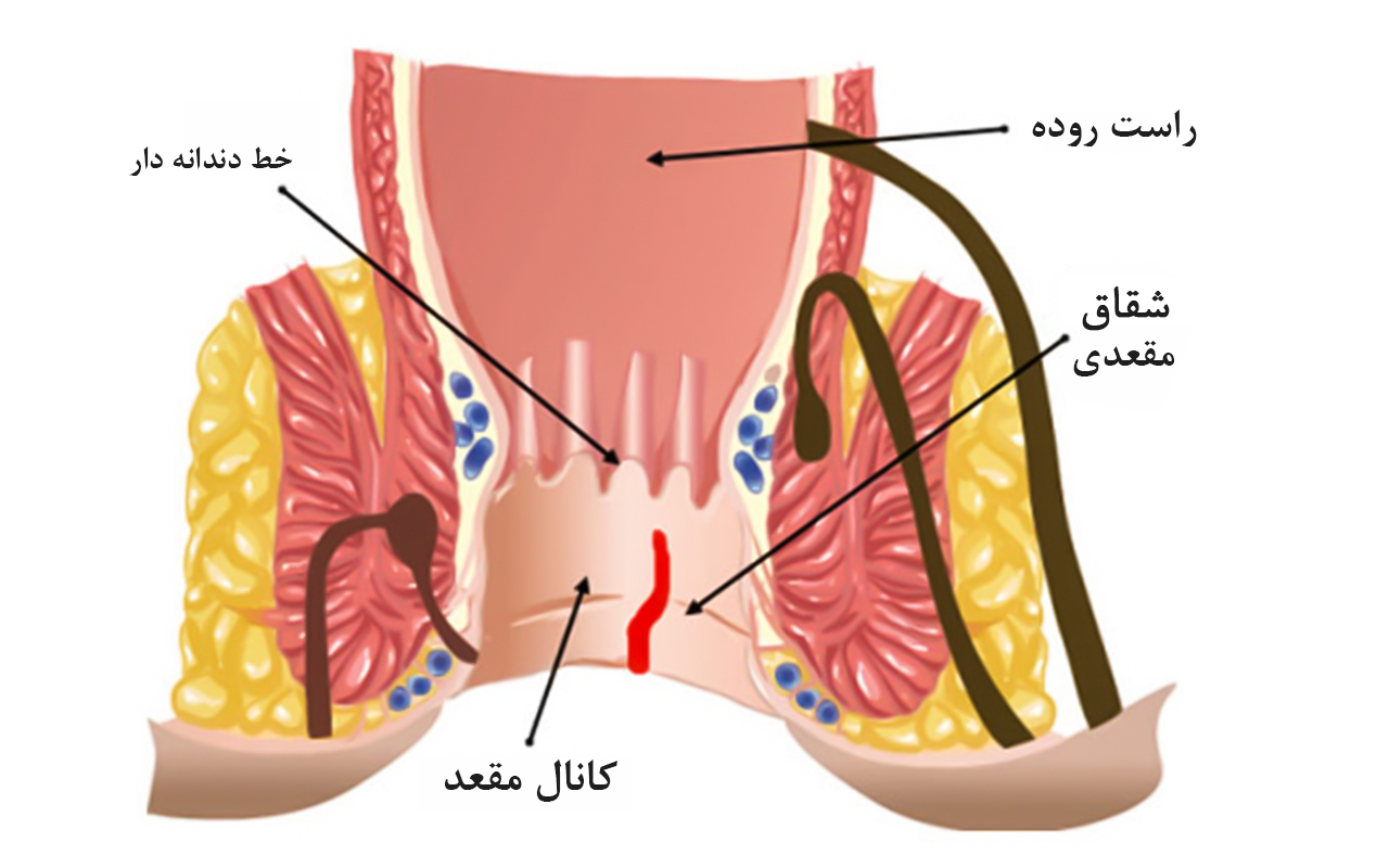 شقاق مقعدی