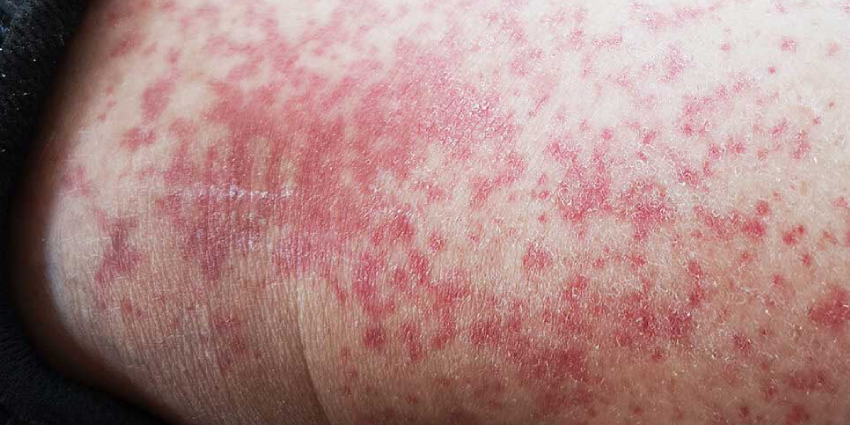 علت به وجود آمدن لیکن پلان چیست؟