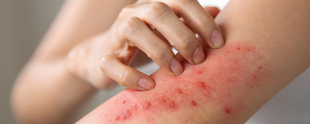 آمپول آماده تزریق امالیزوماب در درمان آلرژی | هرآنچه باید درباره Omalizumab بدانید